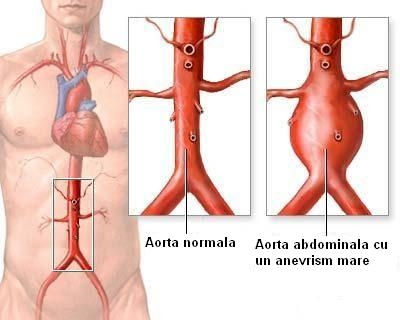 imagine cu anevrismul de aorta